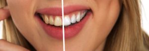 odontología estética blanqueamiento dental carillas de porcelana