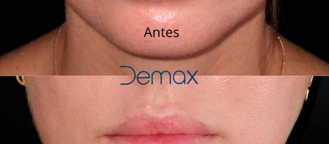 Imagen superior: Aspecto de los labios después de dos años de haber sido tratados con #acidohialuronico en otro centro.
Imagen inferior: Resultado después de haber disuelto el ácido hialurónico con #hialuronidasa.⁣