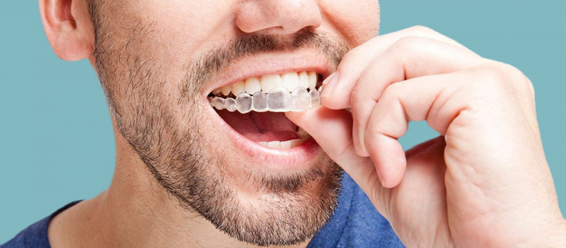 Invisalign-ventajas-inconvenientes-sevilla