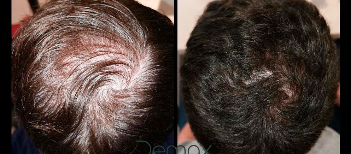 alopecia_post