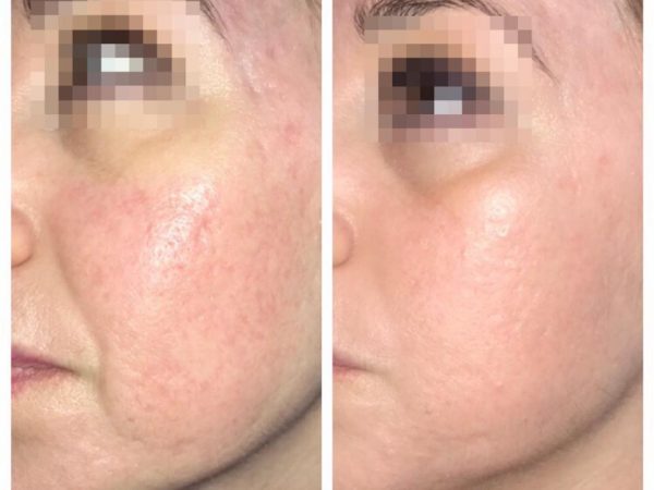 cicatrices atróficas de acné con Viscoderm Hydroboster relleno con ácido hialuronico