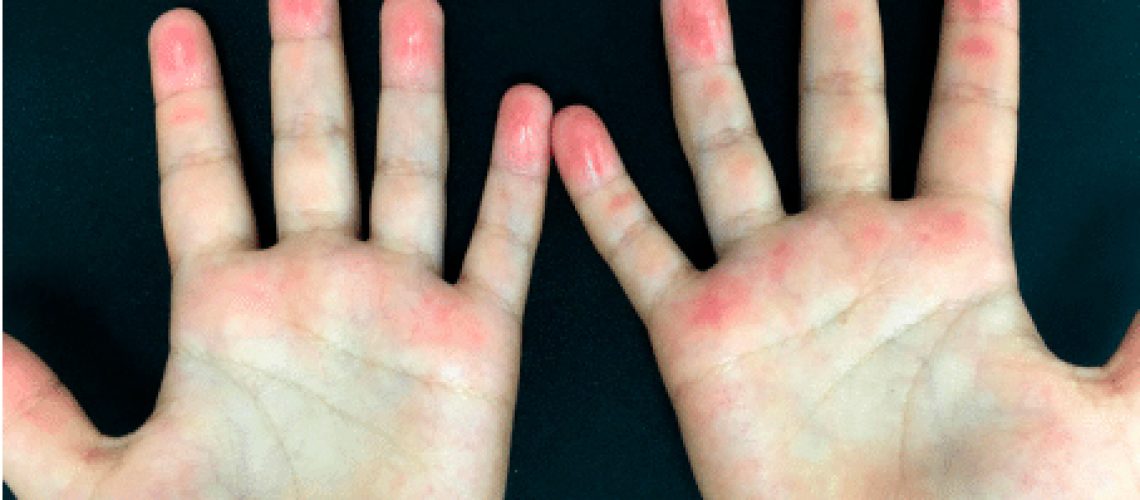 dermatitis_plantar