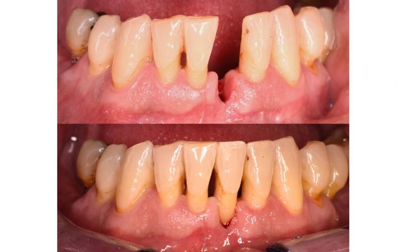 implante-dental-sevilla