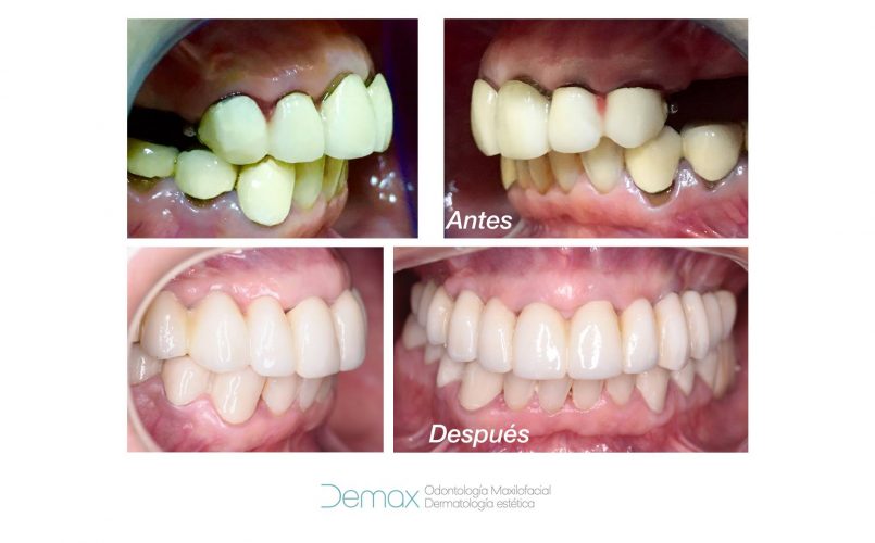 implantes dentales 2