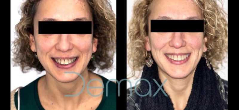 invisalign