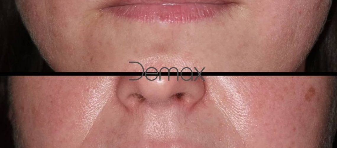 labios