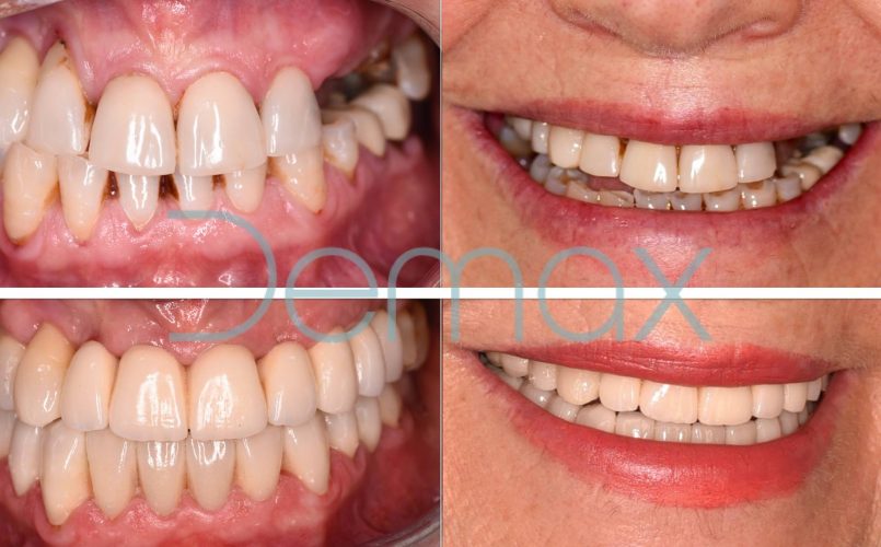protesis-dental-antes-despues