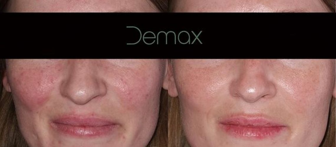rosacea_1