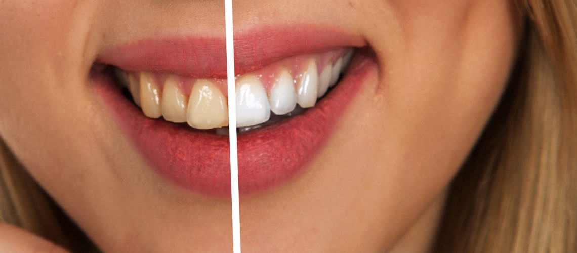 odontología estética blanqueamiento dental carillas de porcelana